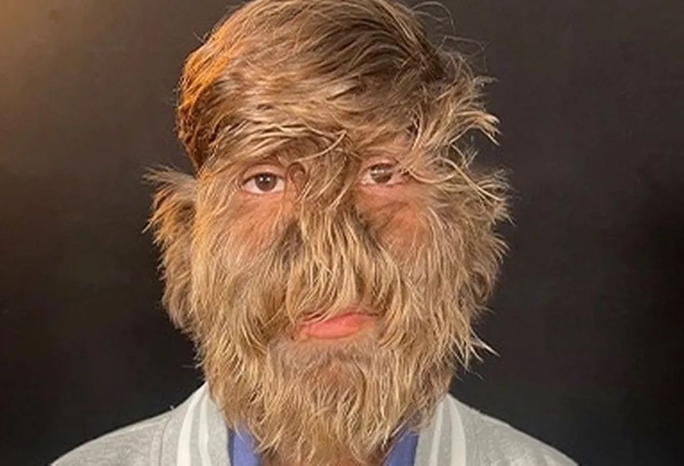 Lalit Patidar, was born with ‘werewolf syndrome