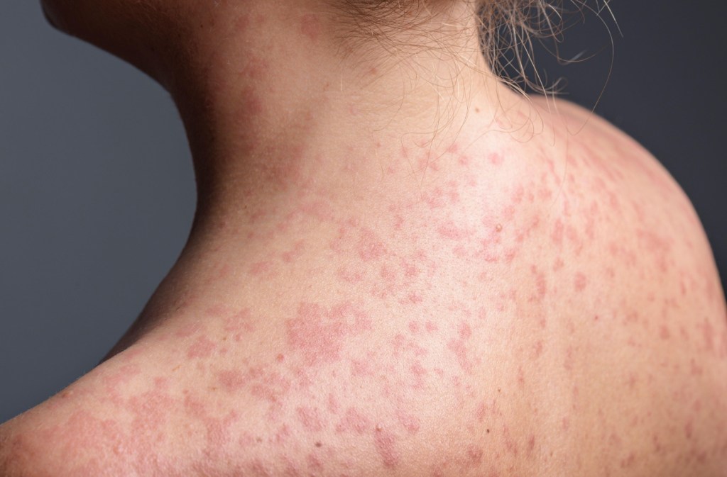 Children could be forced to miss up to three weeks of school in isolation as measles cases continue to surge across parts of the&nbsp;UK